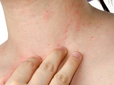 Natural ways to manage eczema flare ups